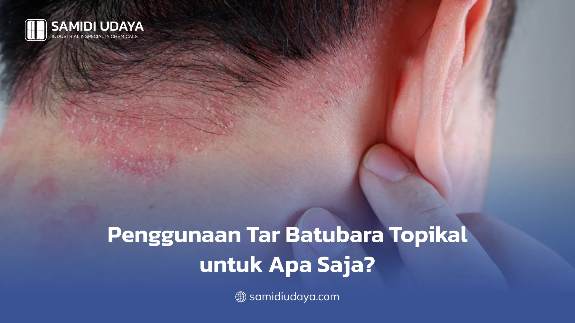 Penggunaan Tar Batubara Topikal untuk Apa Saja?