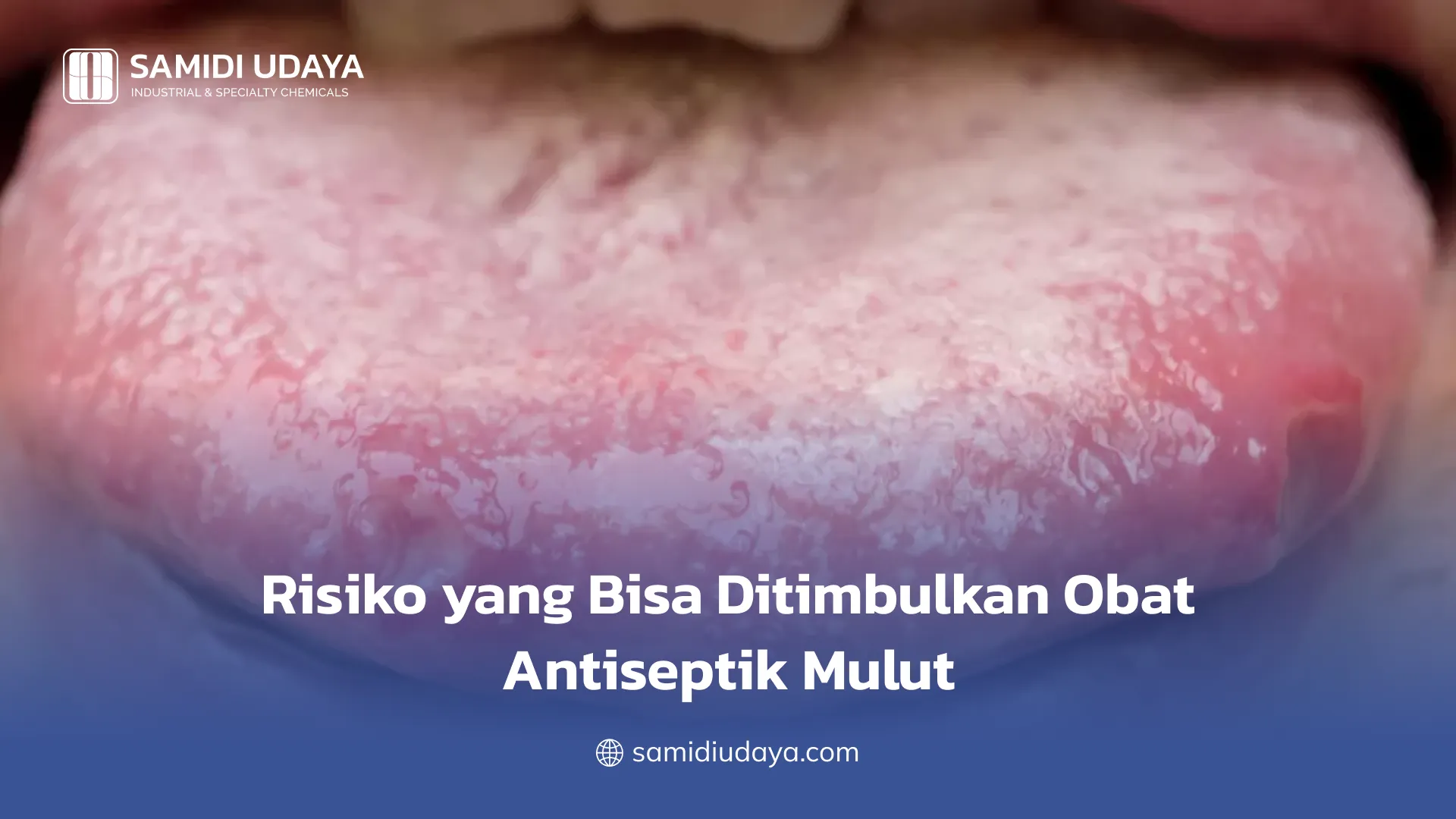 Risiko yang Bisa Ditimbulkan Obat Antiseptik Mulut